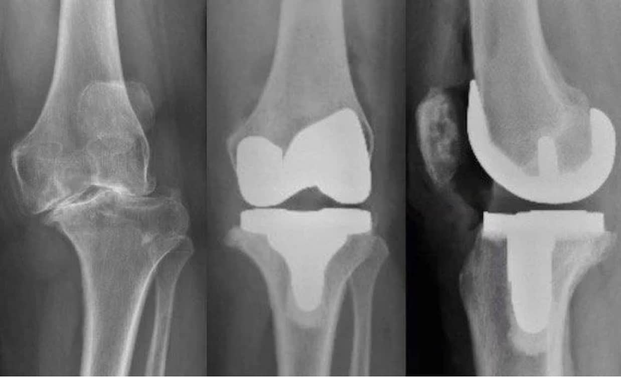 Knee x ray